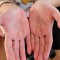 Everything You Need to Know About Dyshidrotic Eczema